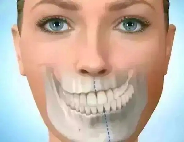 04下巴反咬合.webp.jpg